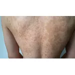 Łupież pstry - przyczyny, objawy i leczenie. Czy łupież pstry jest groźny?