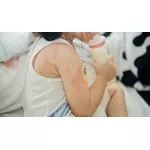 Alergia pokarmowa u dziecka - jakie są objawy i jak leczyć?