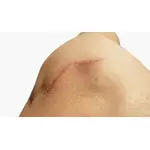 Kolagen na blizny. Czy pomaga i jakie są efekty jego stosowania?