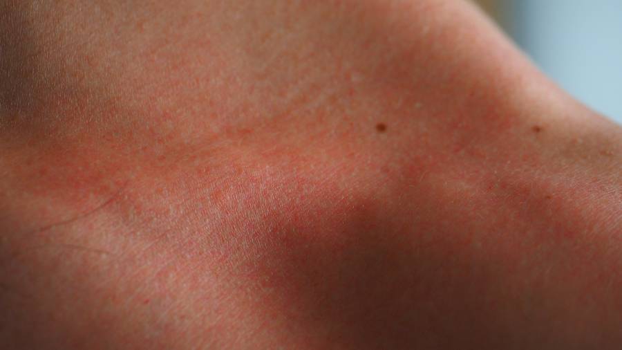 Problemy skórne (Keratosis pilaris) związane z niedoborem witaminy C | iZielnik.pl
