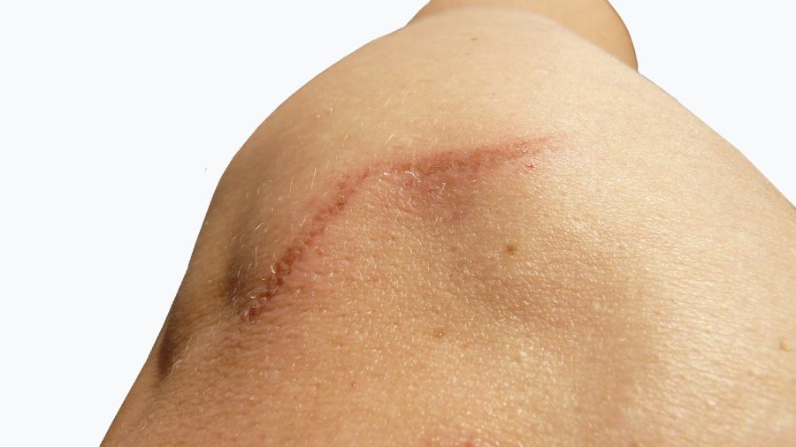 Kolagen na blizny. Czy pomaga i jakie są efekty jego stosowania? | iZielnik.pl