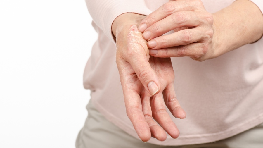 Czy łuszczyca jest zaraźliwa? | iZielnik.pl