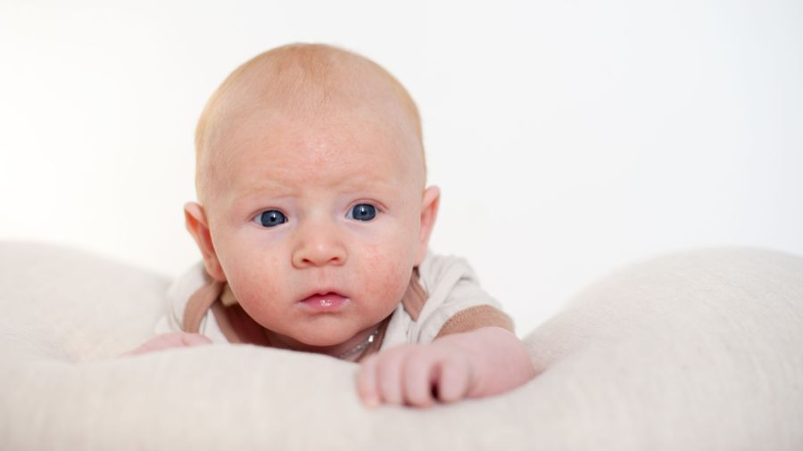 Skaza białkowa u niemowląt - jakie są przyczyny, objawy i jak leczyć? | iZielnik.pl