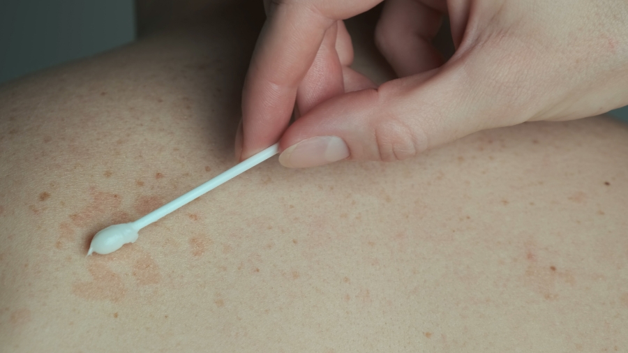 Łupież pstry - wymaz ze skóry